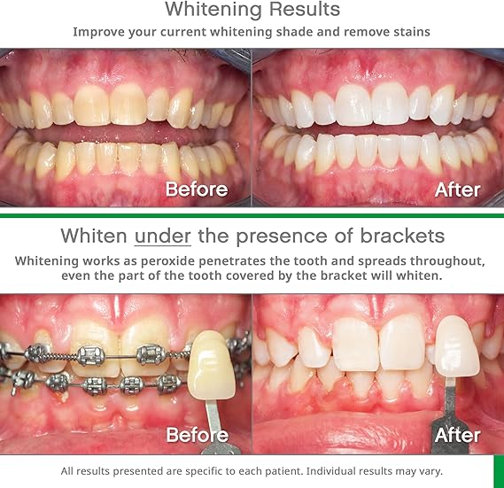 Opalescence Go 10% Teeth Whitening Kit – 10 Treatments Mint